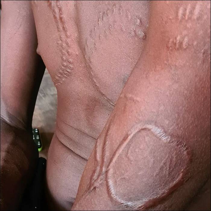 Scarification tribe mursi